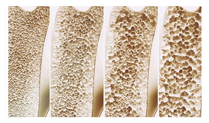 Osteoporosis Workshop