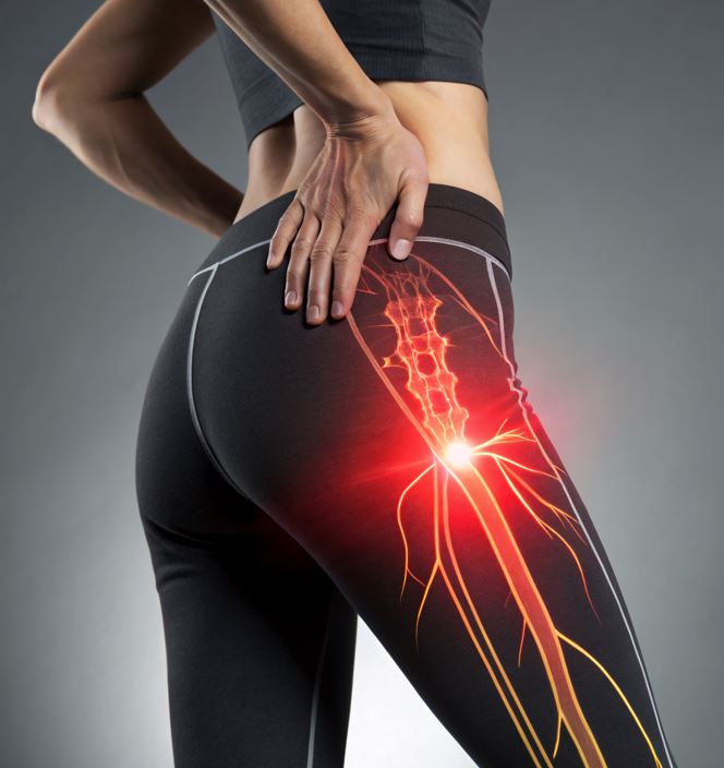 Image of sciatica and nerve pain