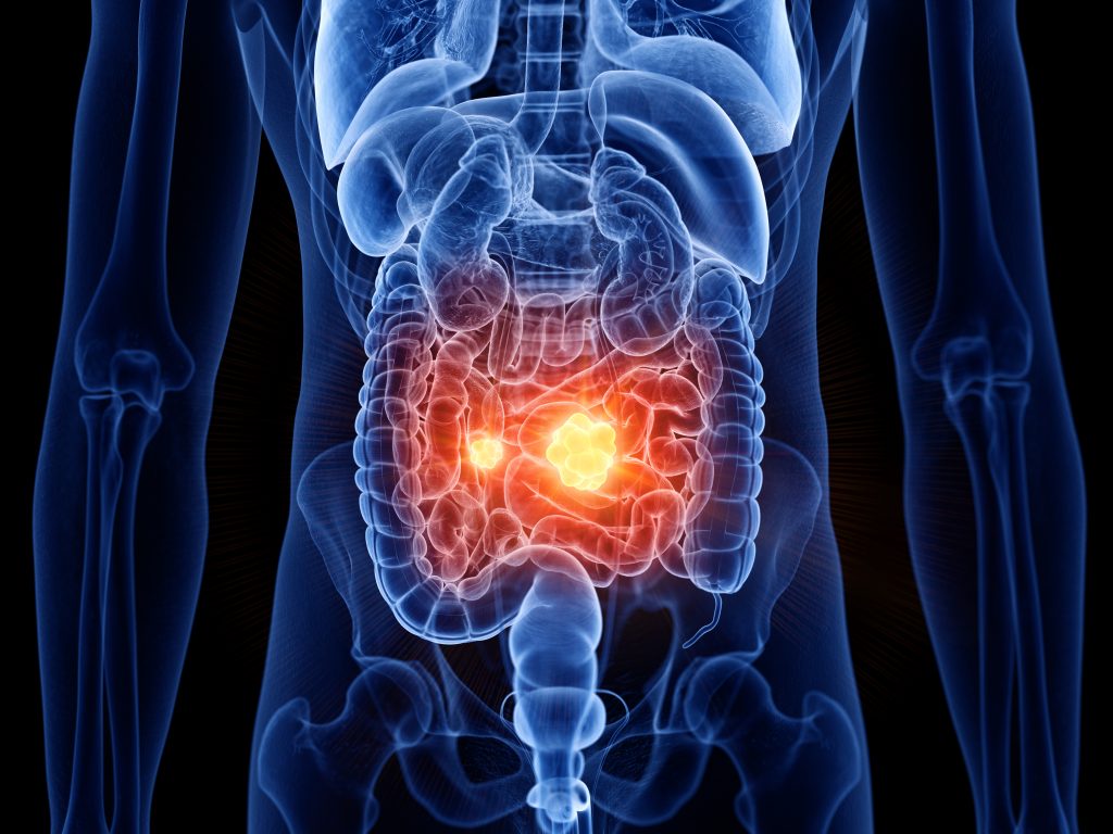 3d rendered medically accurate illustration of small intestine cancer
